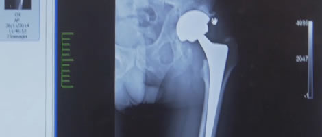radiografia femore con protesi