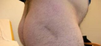 protesi anca post-operatoria cicatrice gluteo