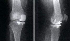 ginocchio rafiografia protesi